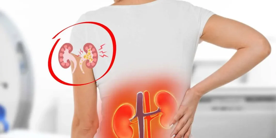 Dolor de Riñones: Ubicación y Causas Comunes que Debes Conocer