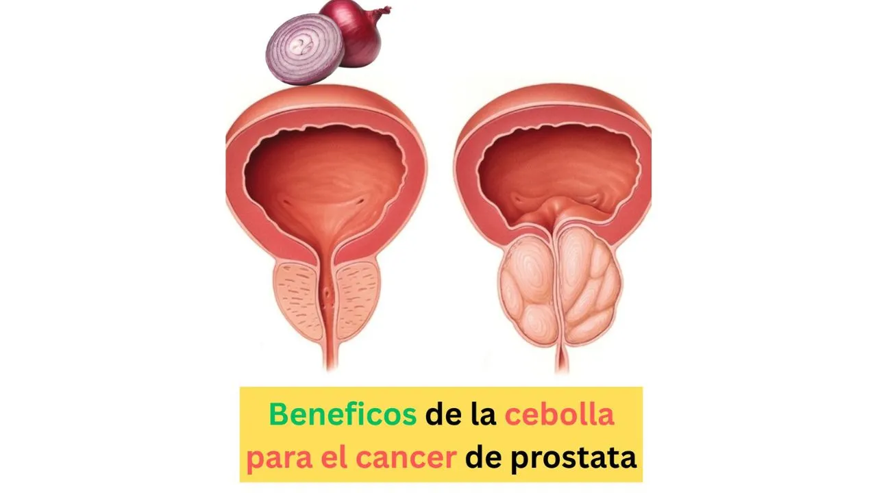 Beneficios de la cebolla para la prostática